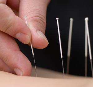 acupunctura