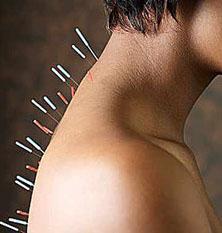acupunctura